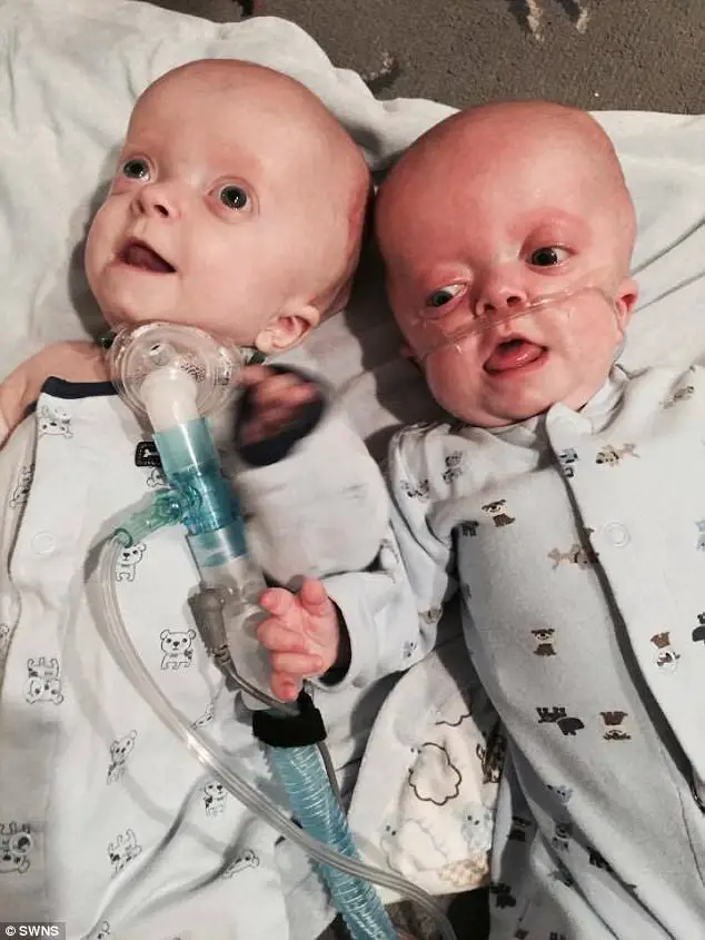 Selfless Grandmother Adopts Baby Twins Born With Rare Genetic Deformity