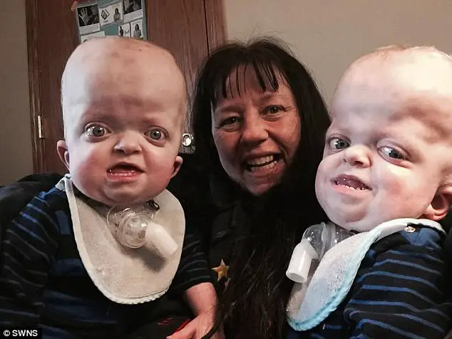 Selfless Grandmother Adopts Baby Twins Born With Rare Genetic Deformity