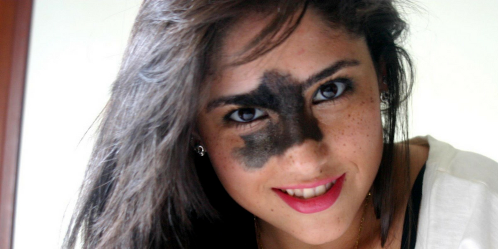 Woman Whose Birthmark Was Described As ‘Ugly’ Flaunts Her Natural Beauty In Empowering Modelling Shoot