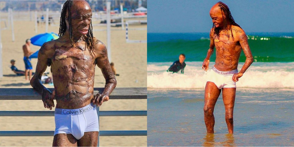 Burn Survivor Ken Dawg Does Beach Photo Shoot To Promote Body Positivity.