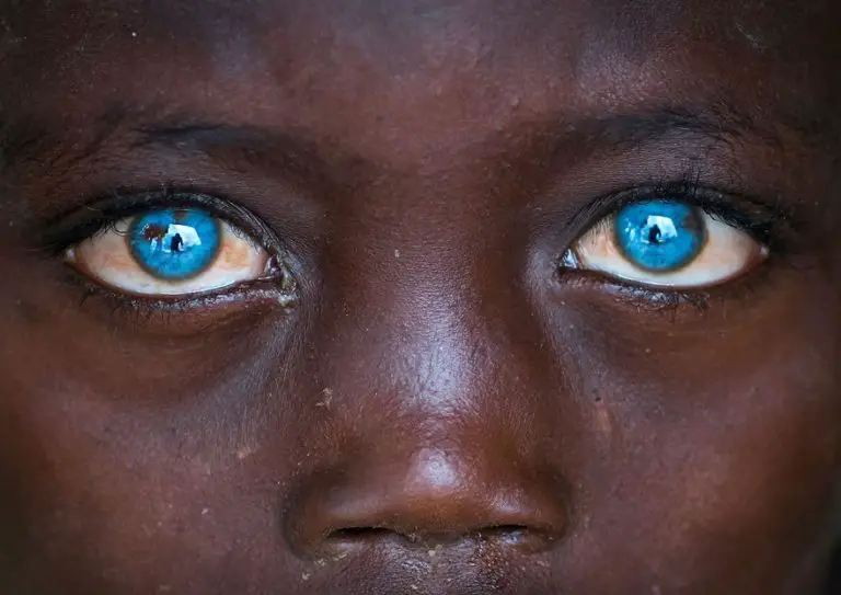 Meet The Ethiopian Boy With The Most Mesmerizing Blue Eyes You Have ...