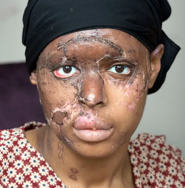 Burns Survivor Naomi Oni Who Was Attacked With Acid By Jealous Friend, Looks Glam In New Photos