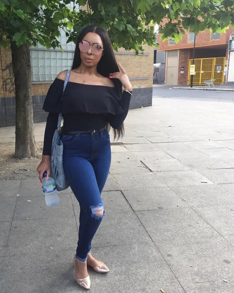 Burns Survivor Naomi Oni Who Was Attacked With Acid By Jealous Friend, Looks Glam In New Photos