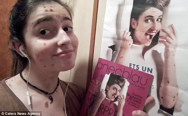 She Was Brutally Bullied For Having Over 500 Birthmarks - Now She's A Top Model!