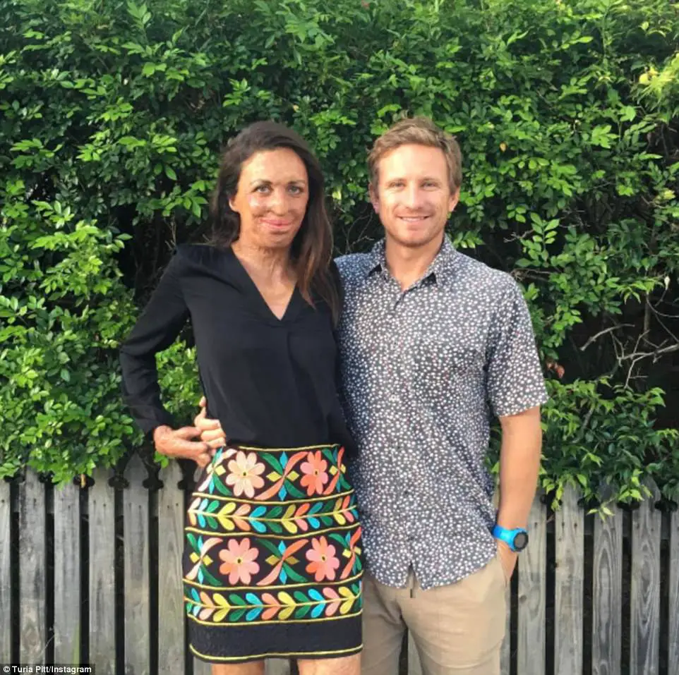 She Was Burned Over 65% Of Her Body. Someone Asked Her Husband If He Still Loved Her. His Response Is BEAUTIFUL