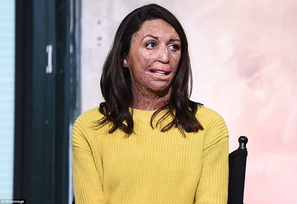 She Was Burned Over 65% Of Her Body. Someone Asked Her Husband If He Still Loved Her. His Response Is BEAUTIFUL