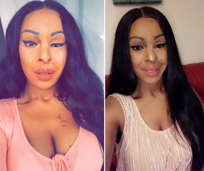 Burns Survivor Naomi Oni Who Was Attacked With Acid By Jealous Friend, Looks Glam In New Photos