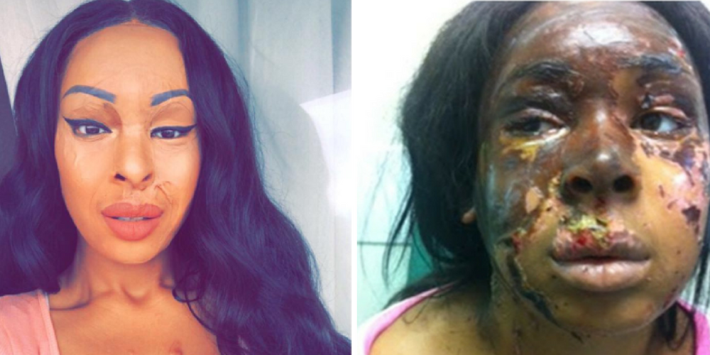 Burns Survivor Naomi Oni Who Was Attacked With Acid By Jealous Friend, Looks Glam In New Photos
