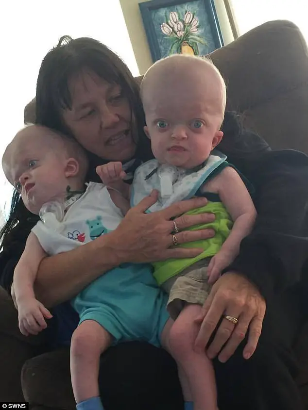 Cette grand-mère avec un grand cœur adopte des jumeaux nés avec une déformation génétique rare (photos)