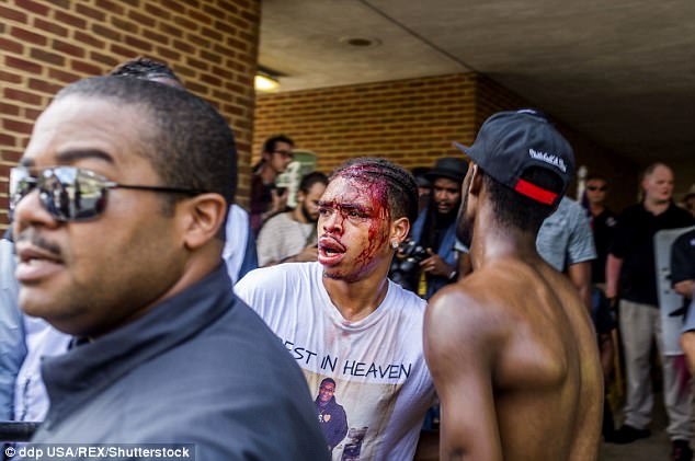 Race Riot Victim Left With Horrifying Wounds After Being Beaten With Sticks By White Supremacists In Charlottesville