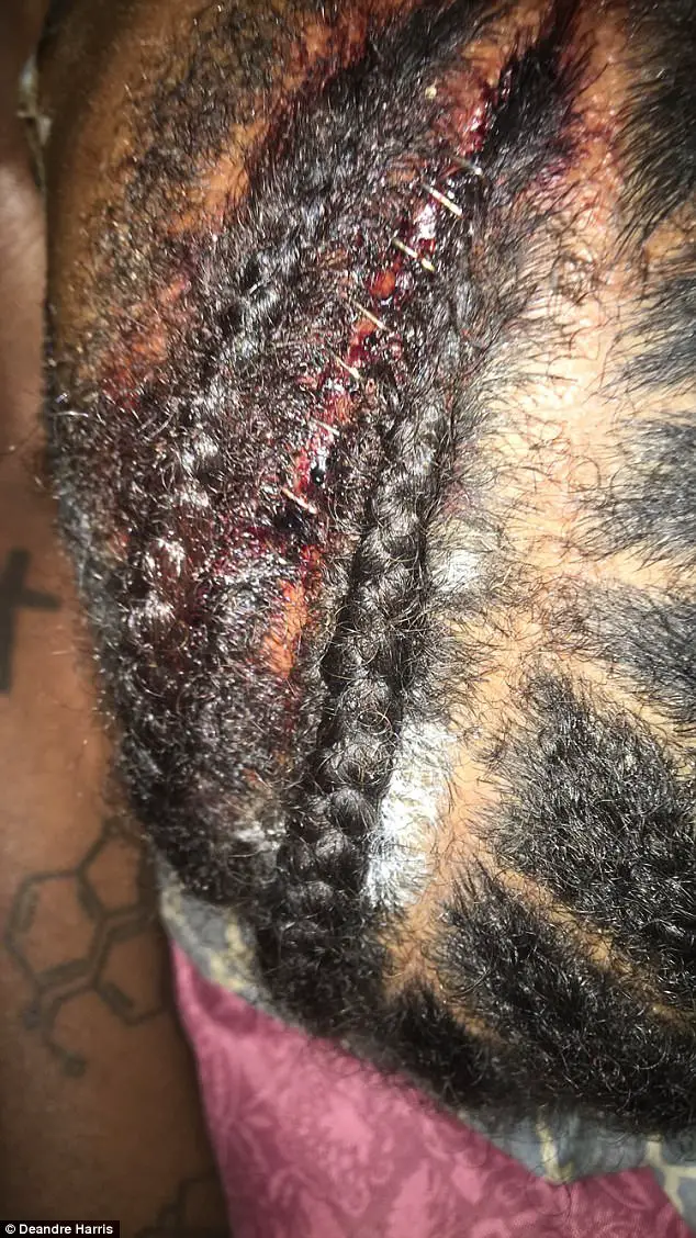 Race Riot Victim Left With Horrifying Wounds After Being Beaten With Sticks By White Supremacists In Charlottesville