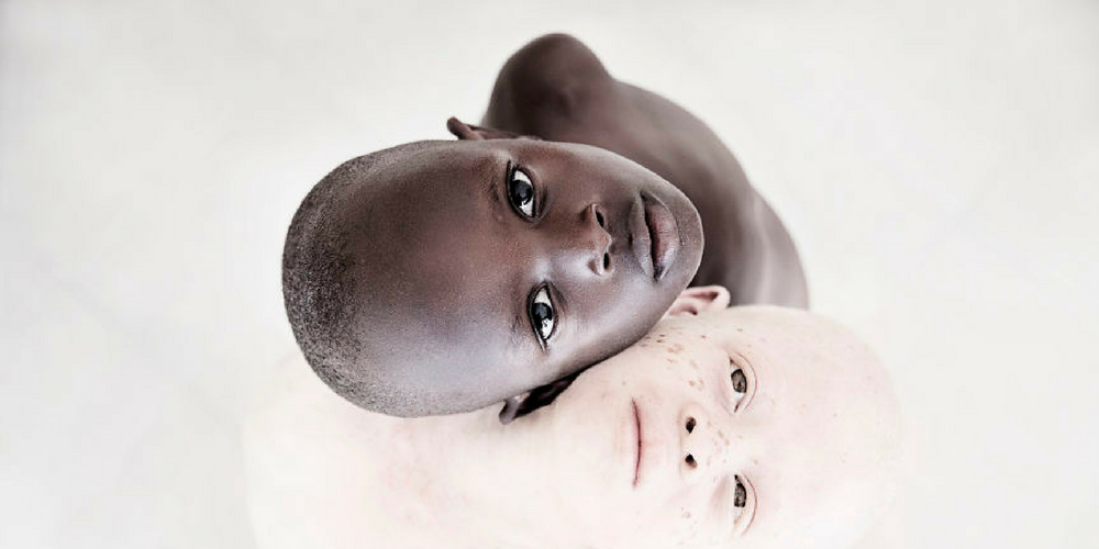 Incredible Images Of Tanzania’s Albino Kids Who Survived Being Killed By Locals Who Believe They Are Witches