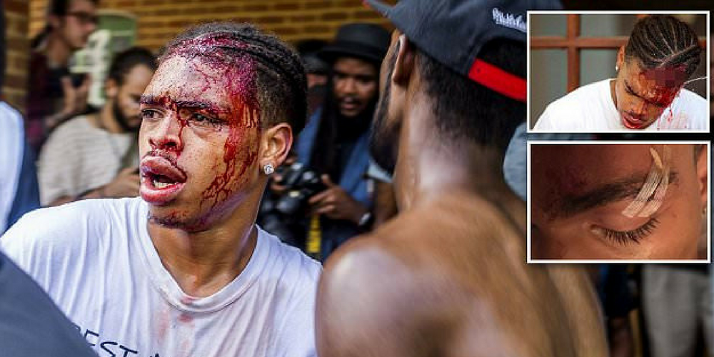 Race Riot Victim Left With Horrifying Wounds After Being Beaten With Sticks By White Supremacists In Charlottesville
