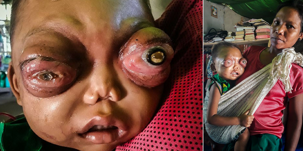 Heartbreaking Pictures Of Two-Year-Old Boy With Painful Protruding Eyes Who Is Slowly Going BLIND