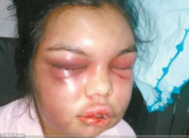 Woman Whose Husband Punched Her Every Time Someone 'Liked' One Of Her Facebook Photos Has To Have Her Face Rebuilt