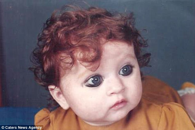 Indian Woman Shunned And Bullied Because Of Her White Skin, Ginger Hair And FRECKLES