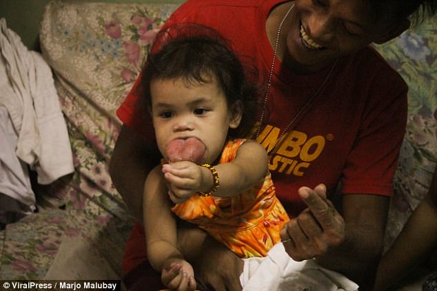 Two - Year- Old Is Slowly Being Suffocated By Her Huge Tumor-Ridden Tongue As Her Family Can't Afford Treatment