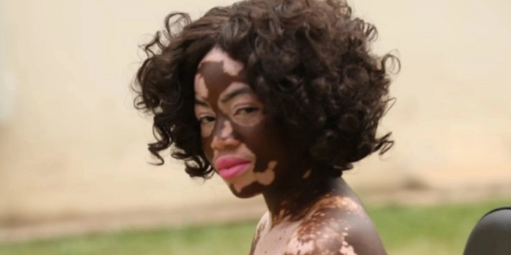 Proud Nurse Fights Against Discrimination Of Her Rare Skin Condition In Native Ghana