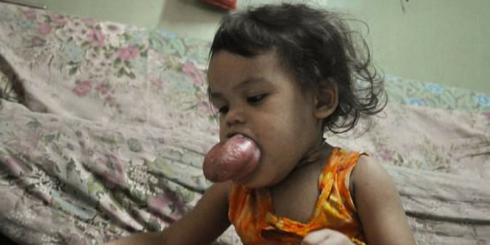 Two – Year- Old Is Slowly Being Suffocated By Her Huge Tumor-Ridden Tongue As Her Family Can’t Afford Treatment