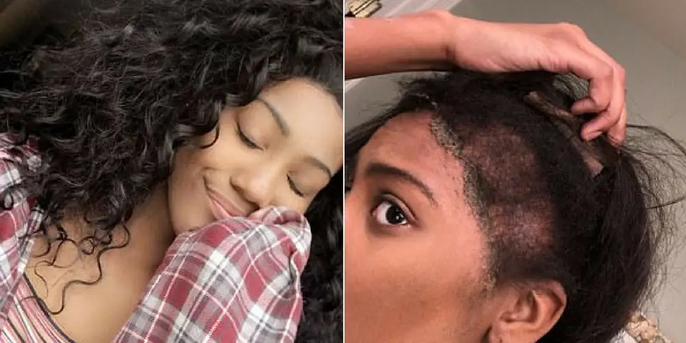 Shocking Moment High School Bullies Rip Off Wig Of Girl With Severe Scalp Condition