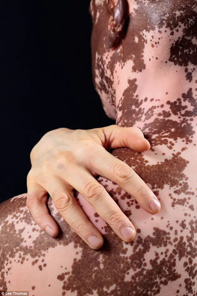 Local Fox TV Reporter With Vitiligo Reveals He Covers Up His Skin Patches With Make-Up So He Isn't A 'Distraction' On Screen