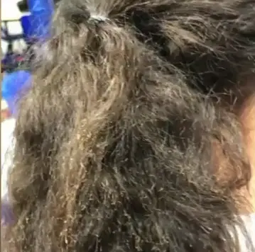 Mother Furious After Her Daughter's Hair Was Set on Fire by a Classmate and Teacher Did Nothing