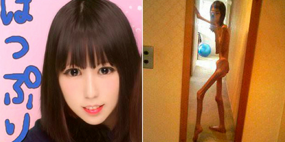 Japanese Woman Shares Shocking Images From When She Weighed Just 37lbs Before She Was ‘Rescued From Abusive Grandfather Who Starved Her’