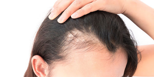 Androgenetic Alopecia: What is It?