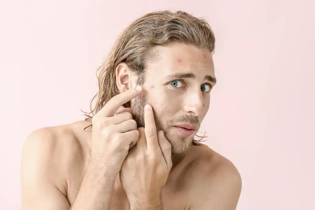 How An Underlying Condition Can Be The Cause Of Your Acne