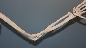 What You Should Know About Rheumatoid Arthritis