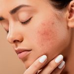 Banish Acne with Medicated Treatments