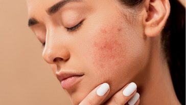 Banish Acne with Medicated Treatments