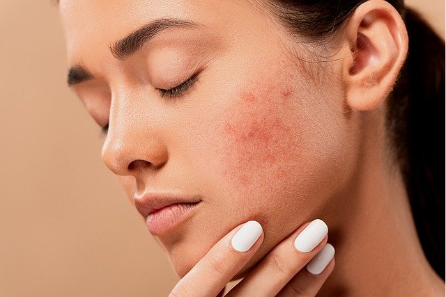 Banish Acne with Medicated Treatments