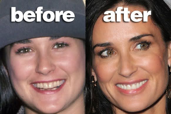 13 Celebrities Who Have Veneers