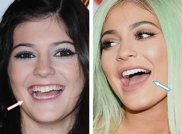 13 Celebrities Who Have Veneers