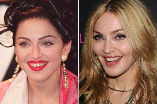 13 Celebrities Who Have Veneers