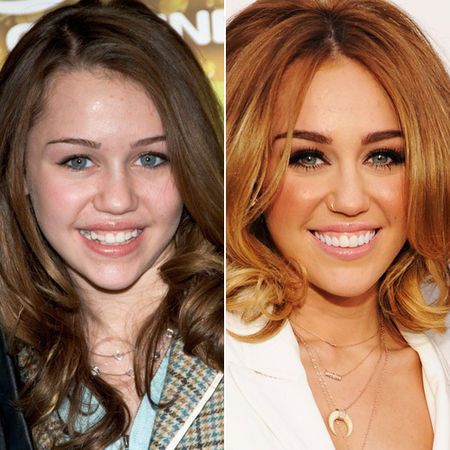 13 Celebrities Who Have Veneers