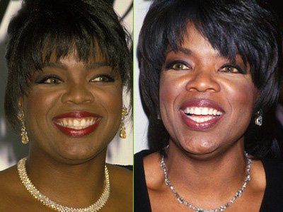 13 Celebrities Who Have Veneers