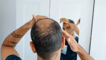 Hair loss
