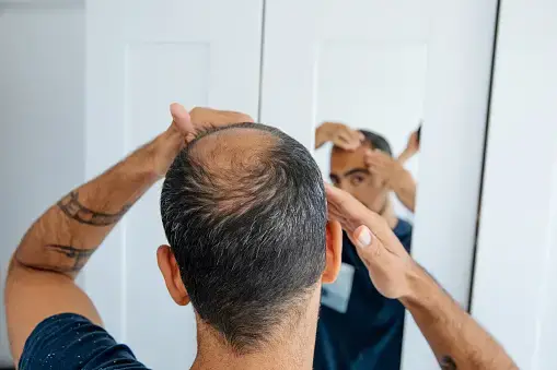 Hair Today, Gone Tomorrow - The World’s Quirkiest Baldness Remedies Throughout History
